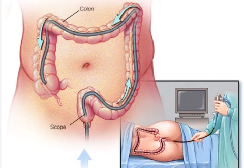 Ung thư đại tràng có thể phát hiện sớm bằng cách nào?